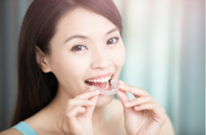 invisalign, straight teeth, braces, clear aligners